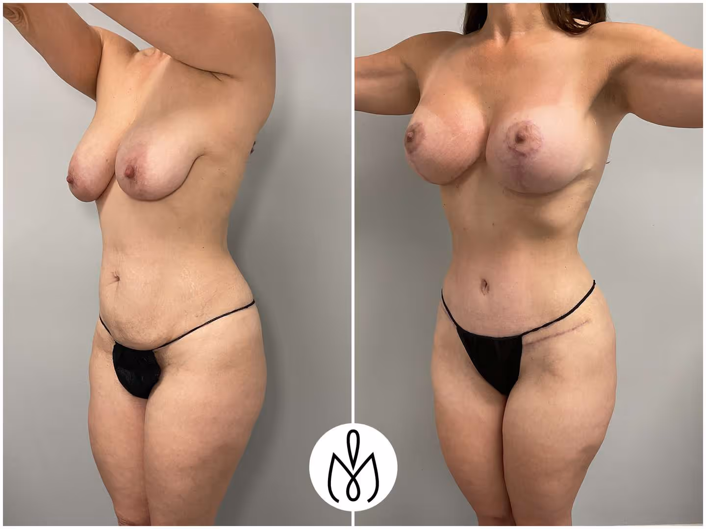 Before,After