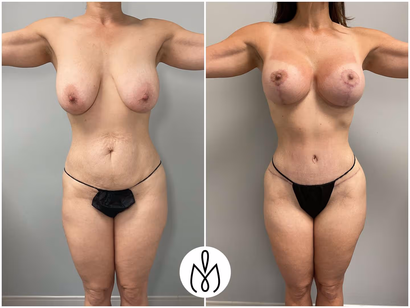 Before,After