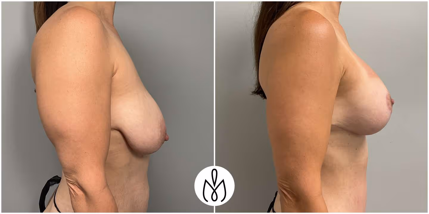 Before,After