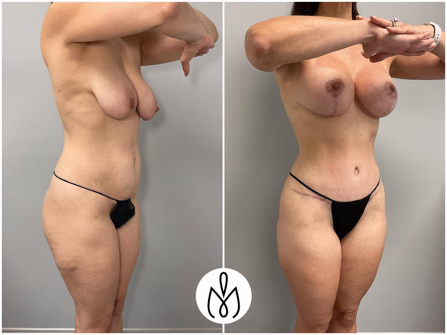 Before,After