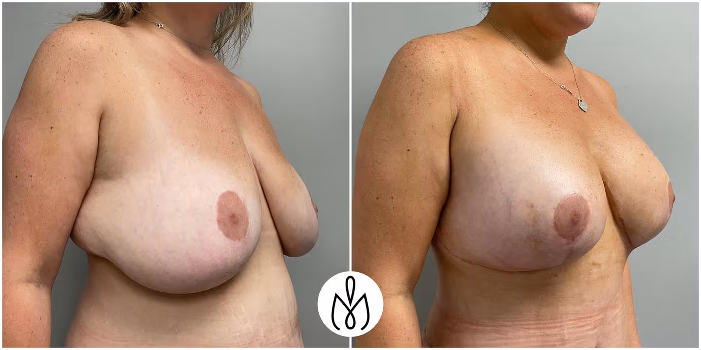 Before,After