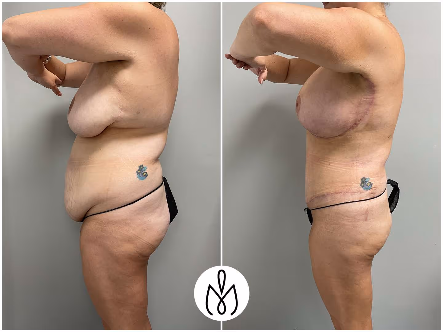 Before,After