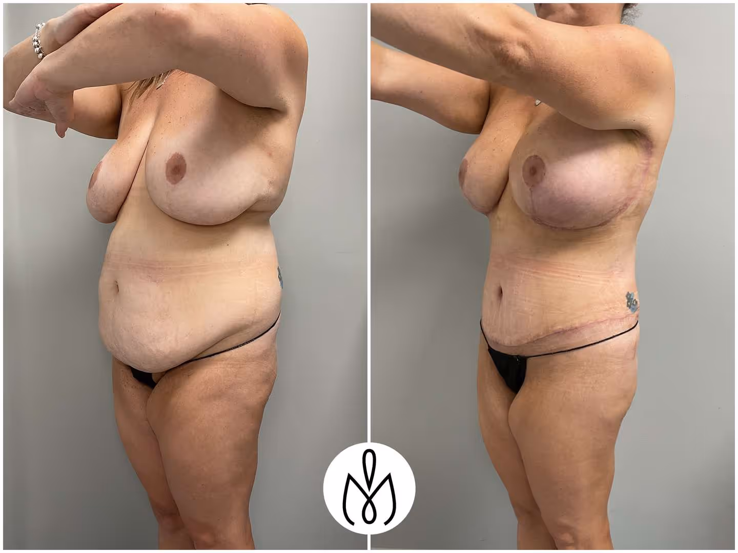 Before,After