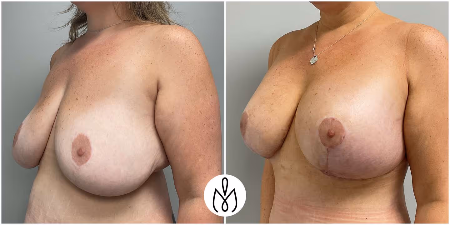 Before,After