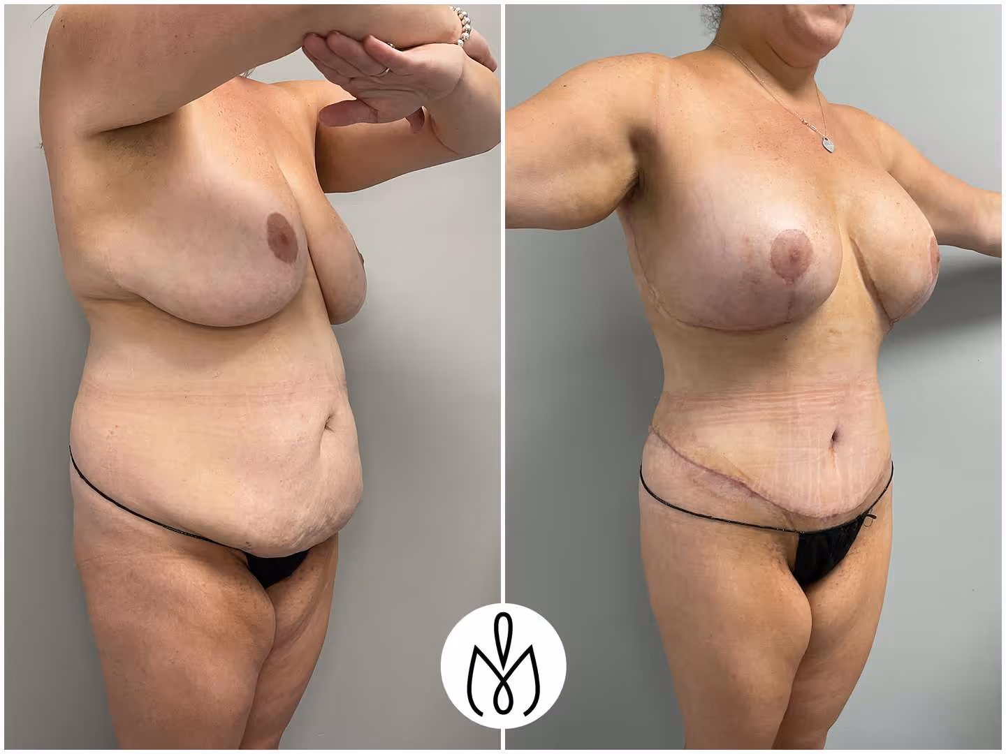 Before,After