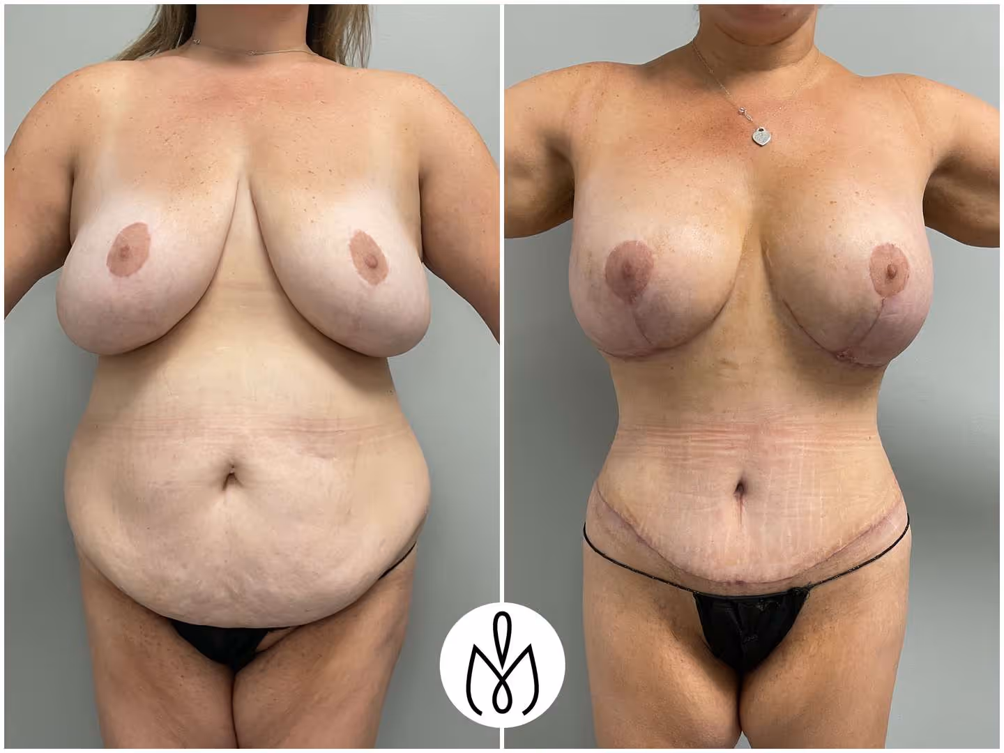 Before,After