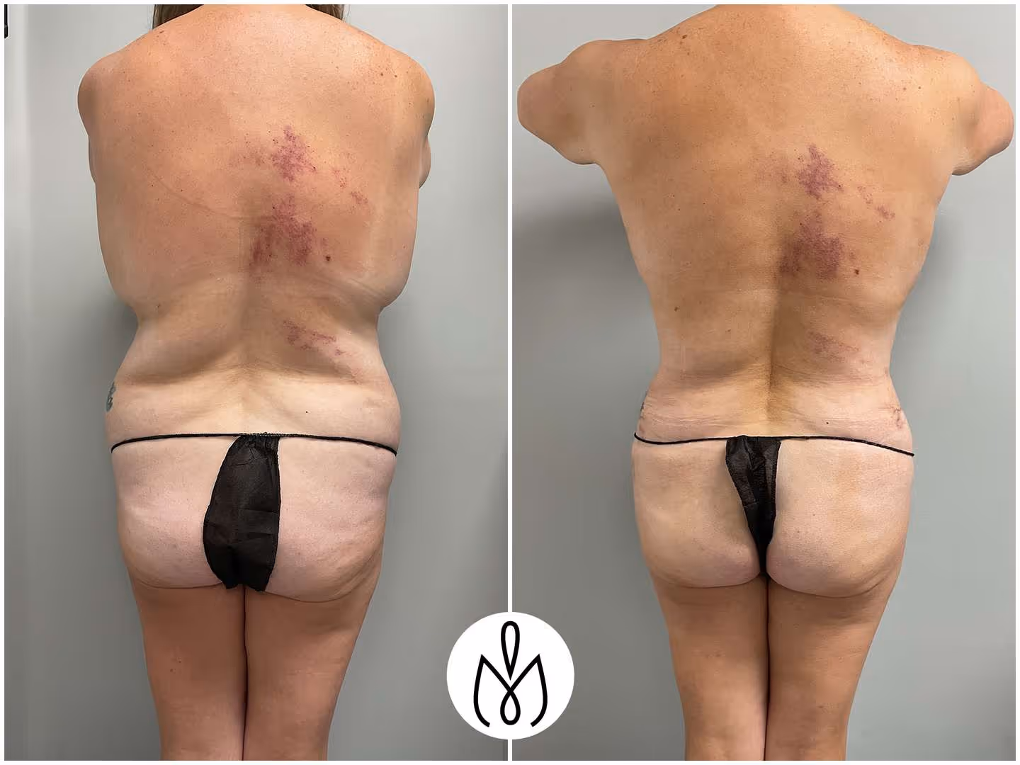 Before,After