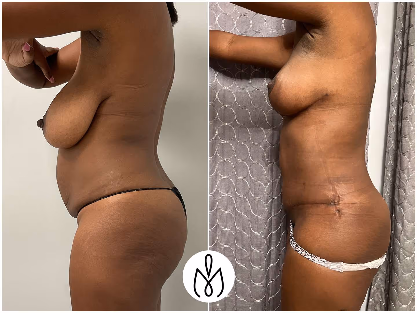 Before,After