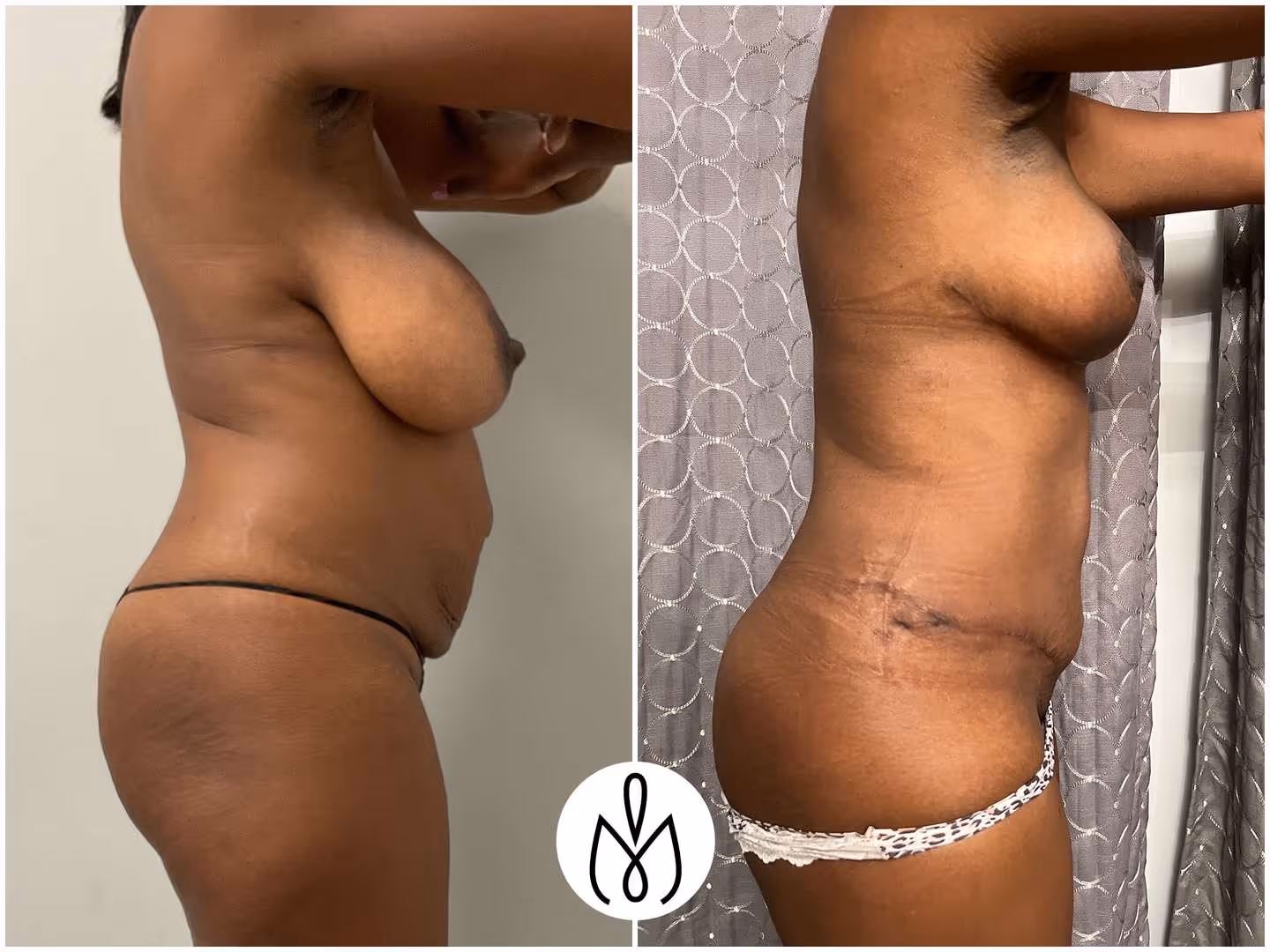 Before,After