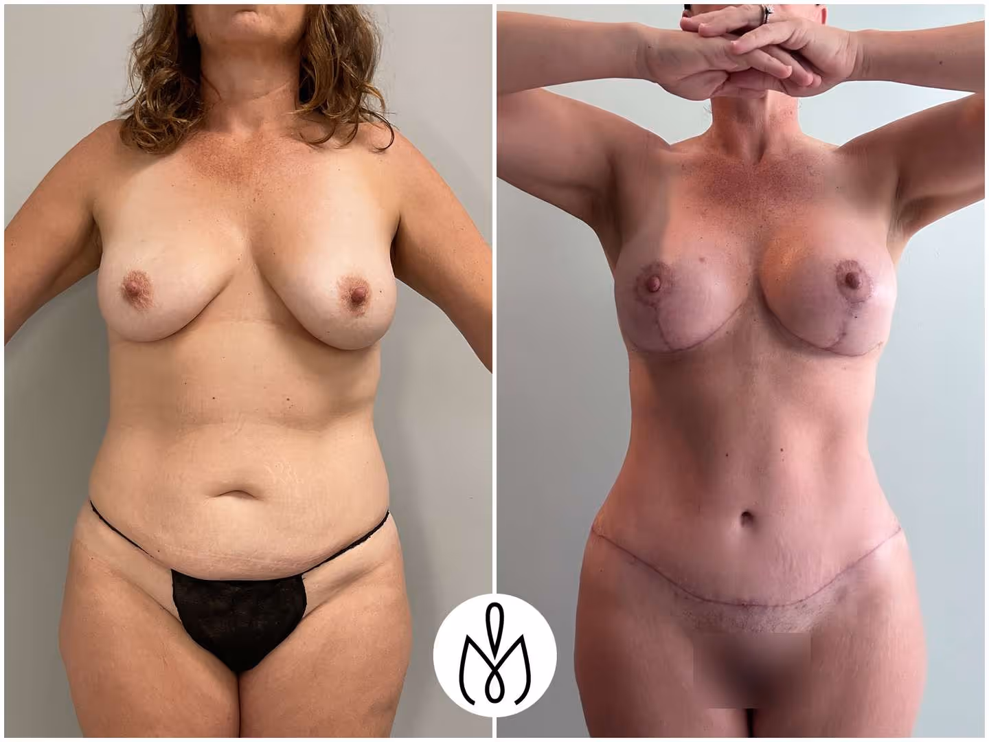 Before,After