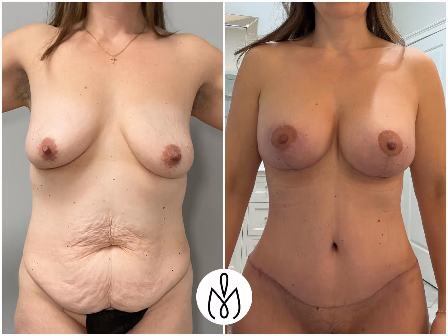 Before,After