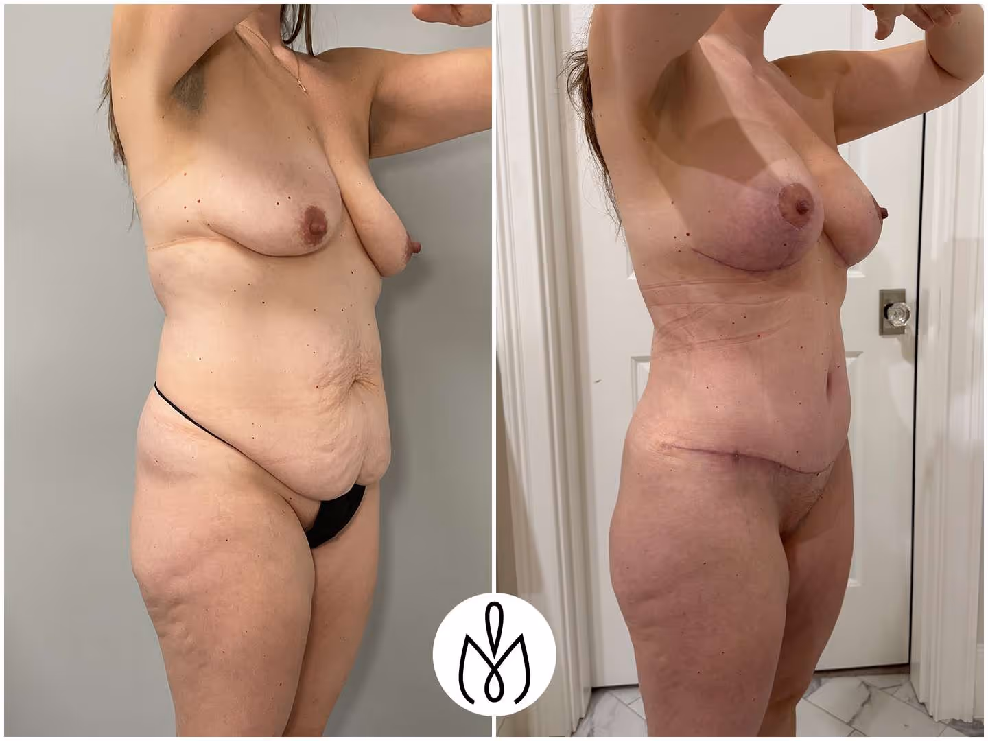 Before,After