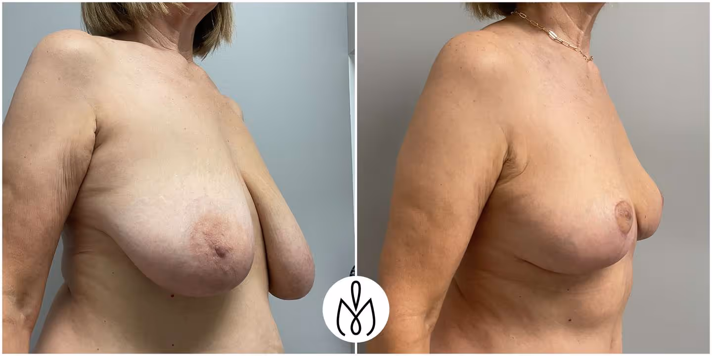 Before,After