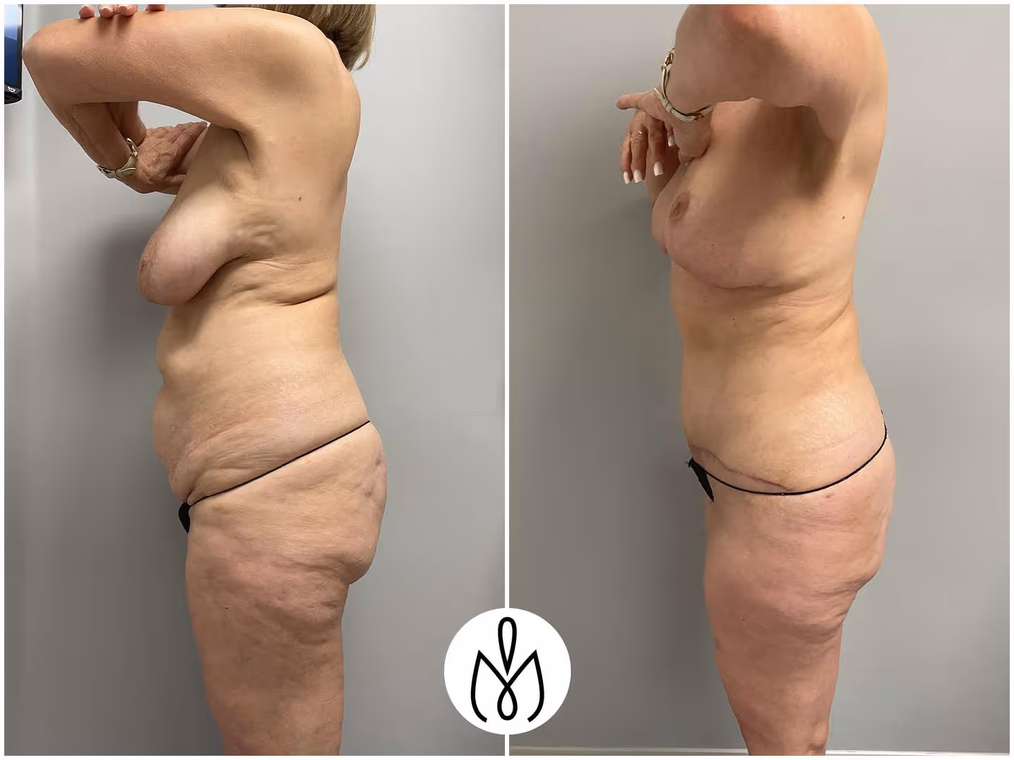 Before,After