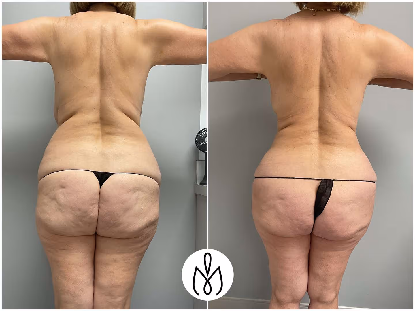 Before,After