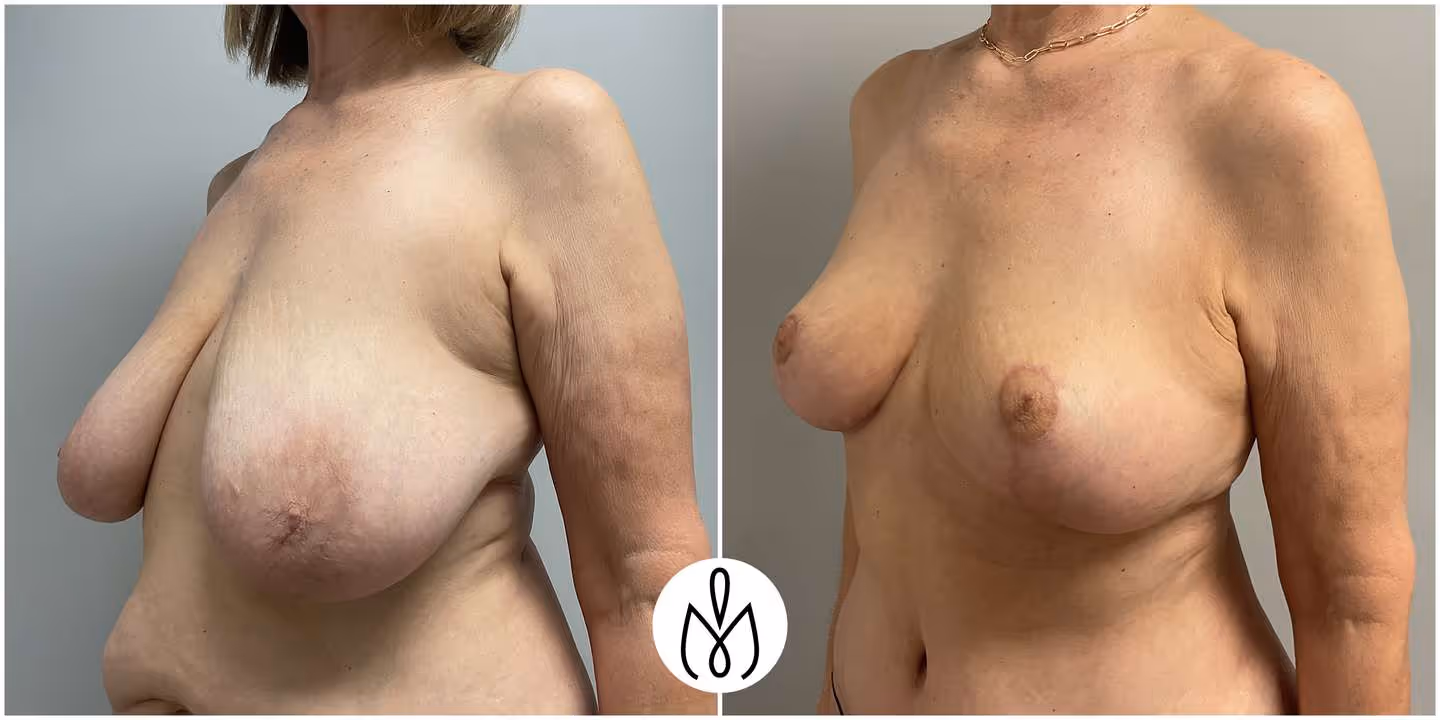 Before,After