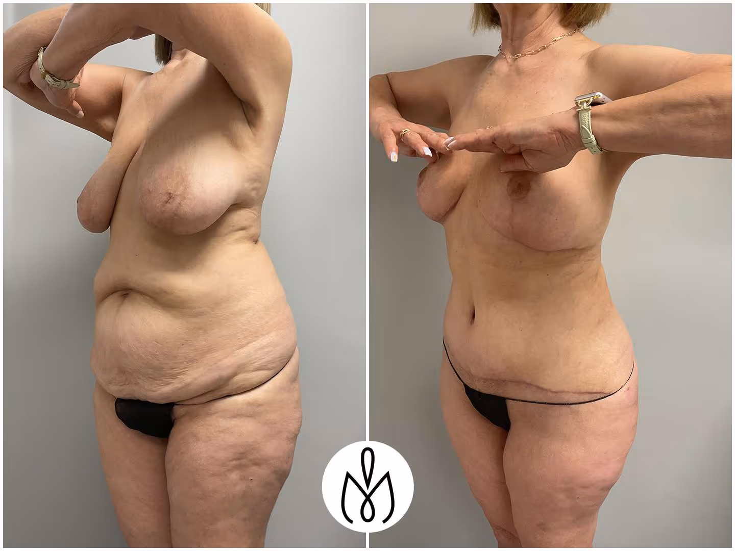 Before,After