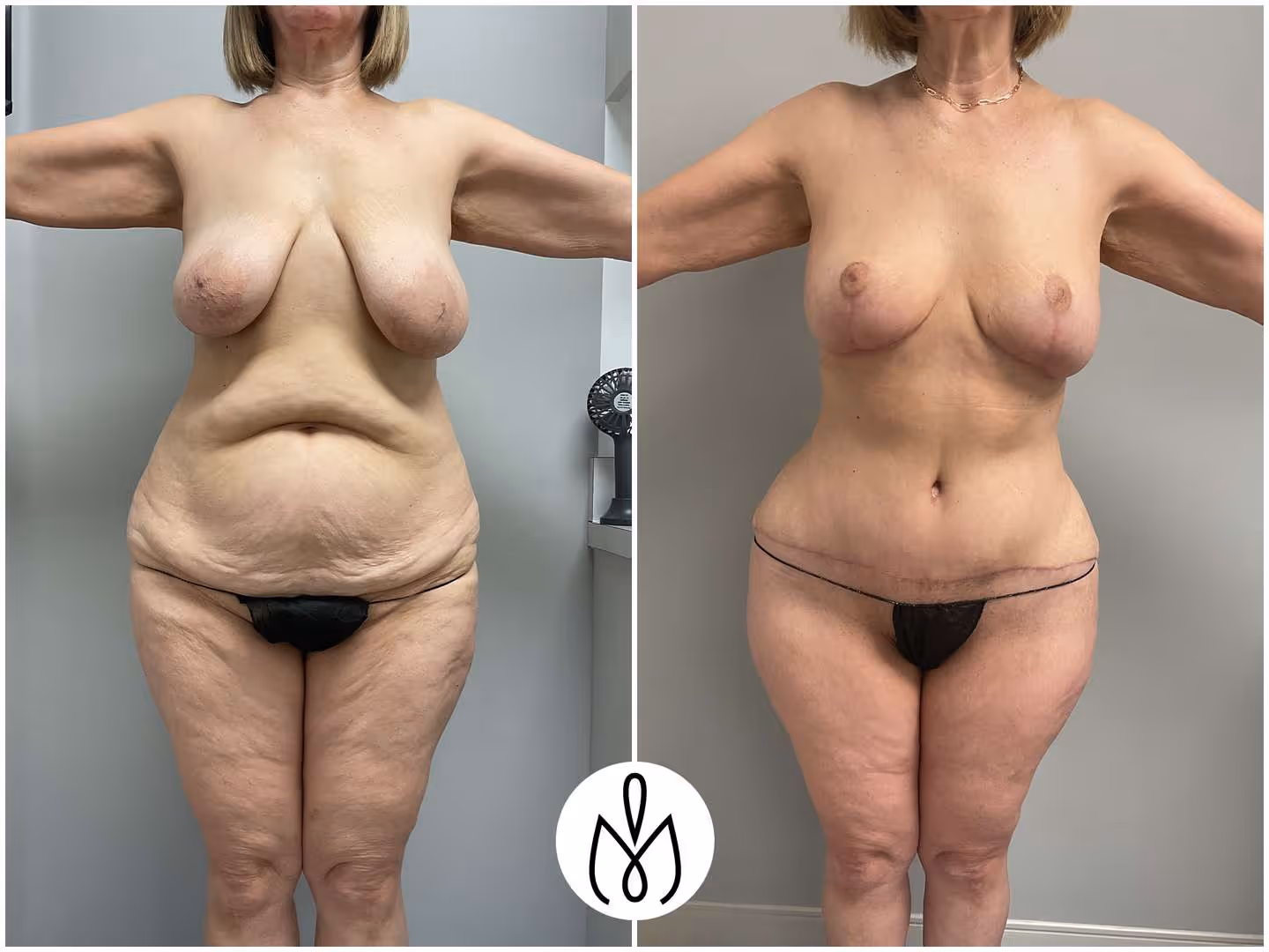 Before,After