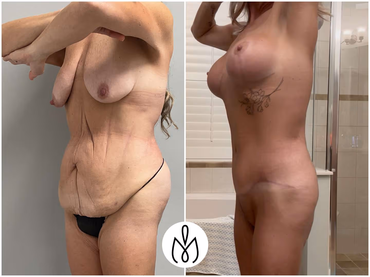 Before,After