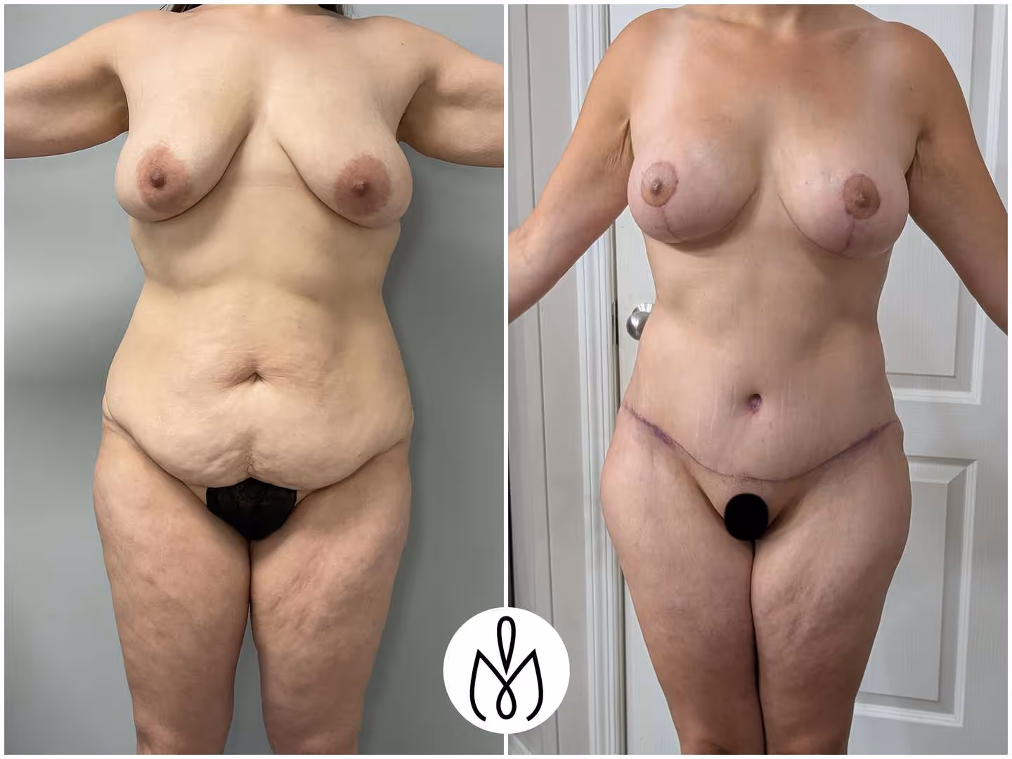 Before,After