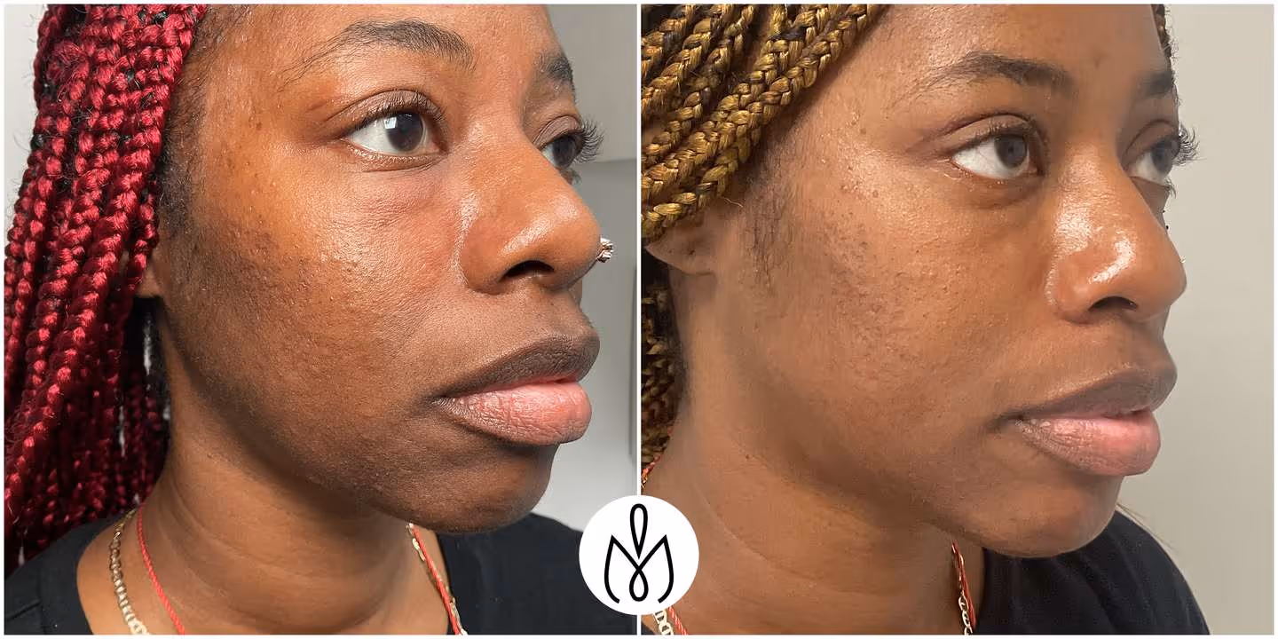 Before,After