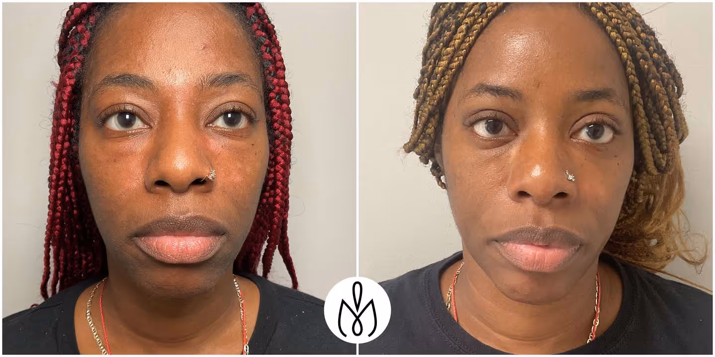 Before,After