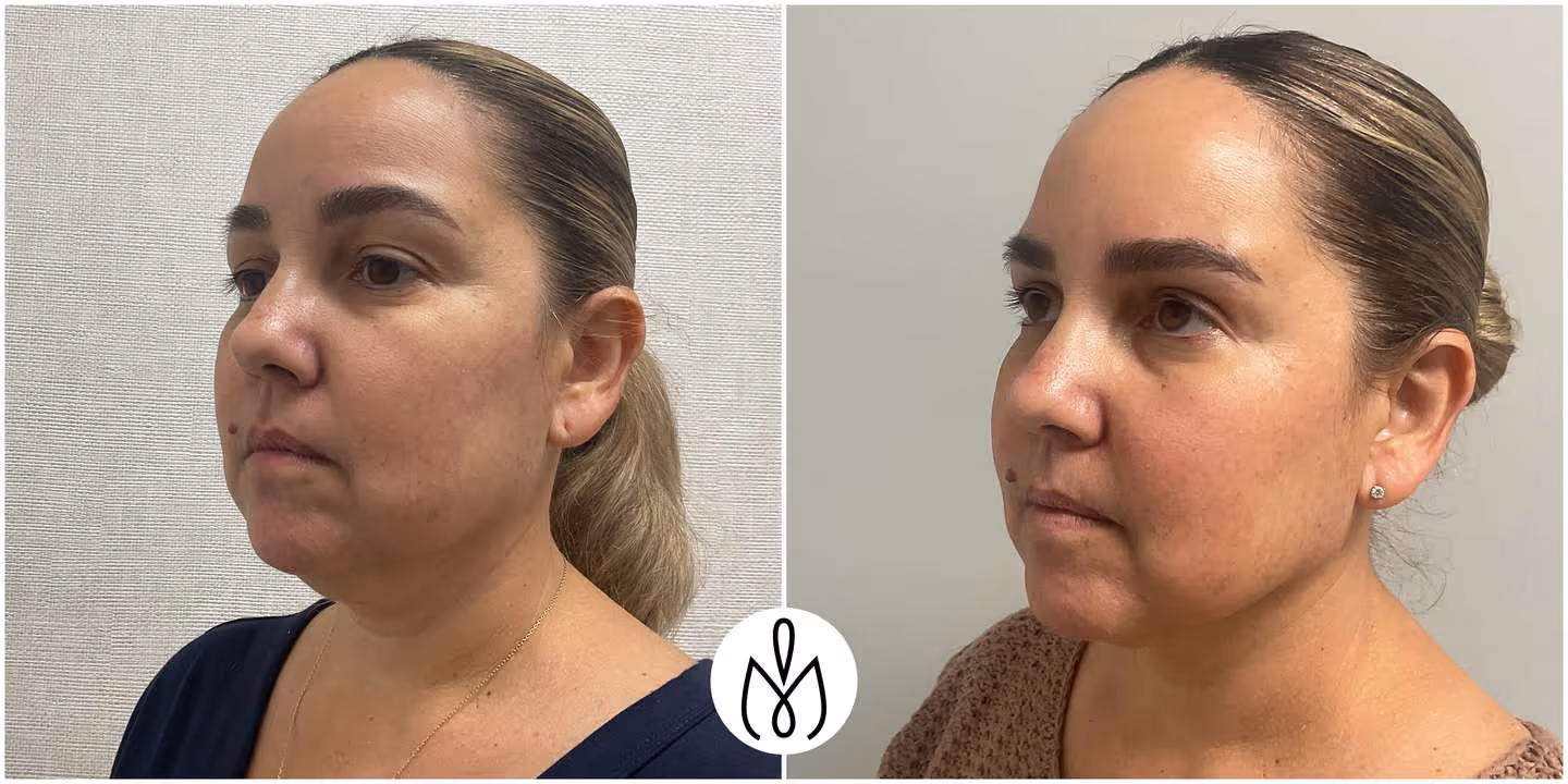 Before,After