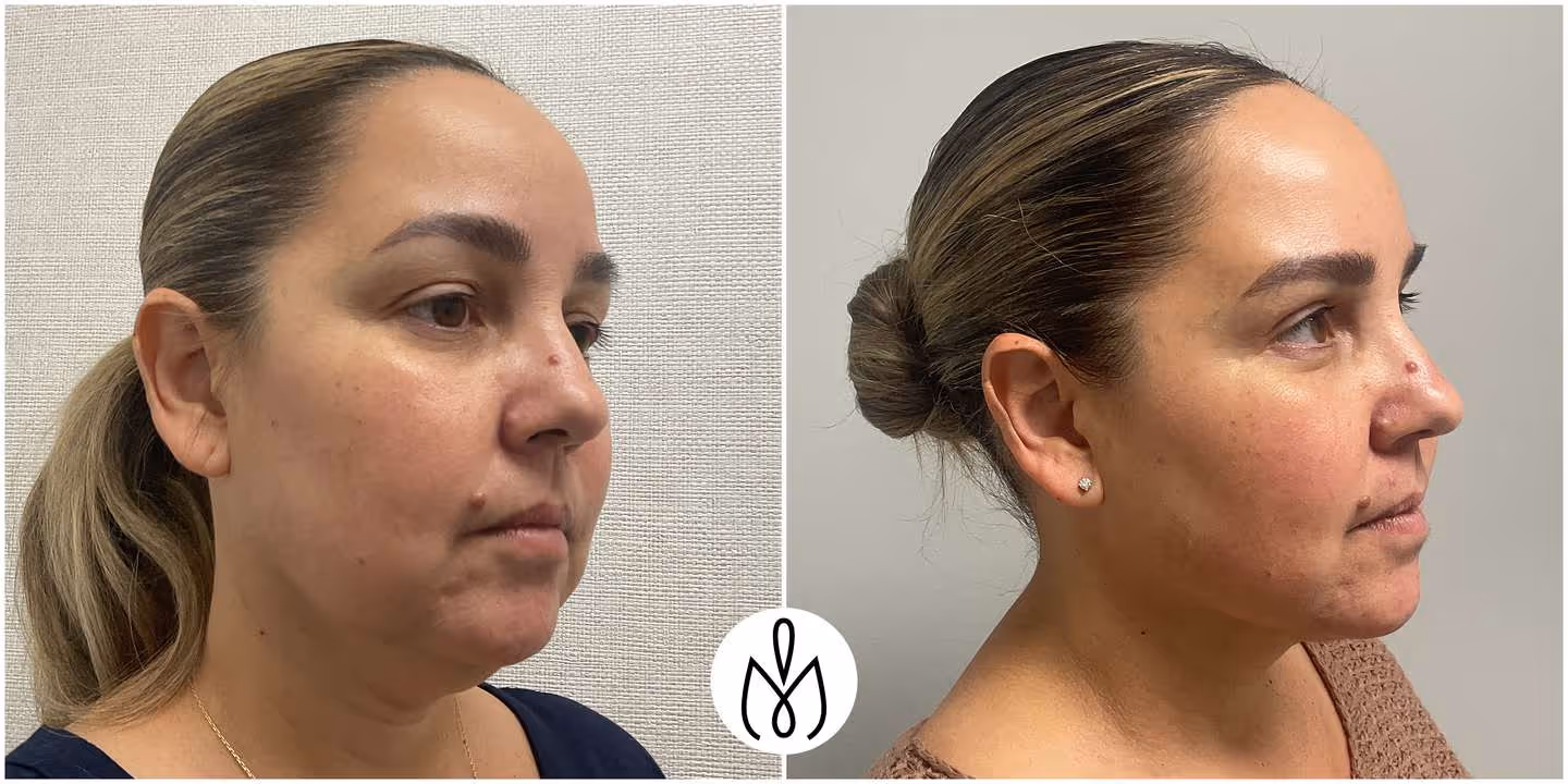 Before,After