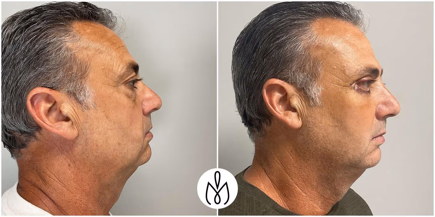 Before,After
