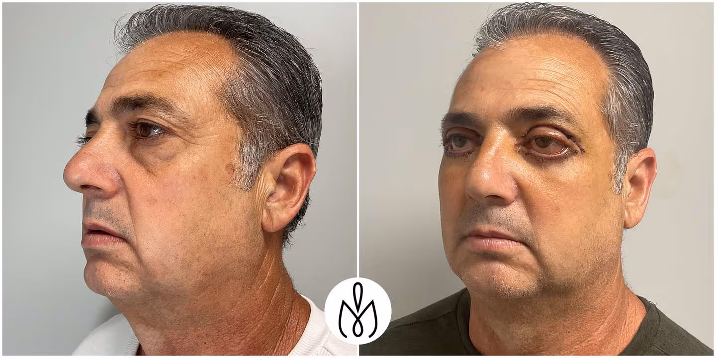 Before,After