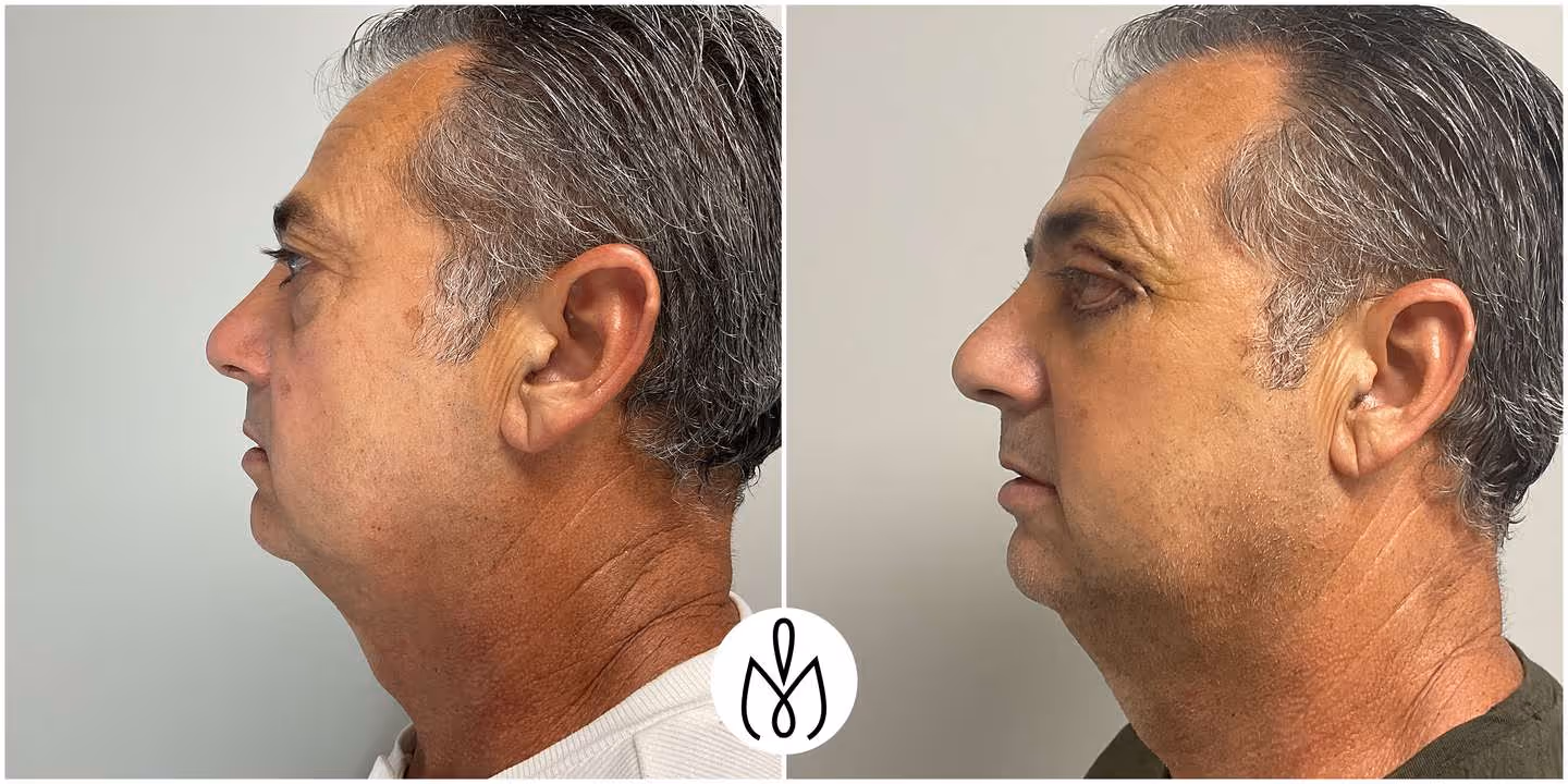 Before,After