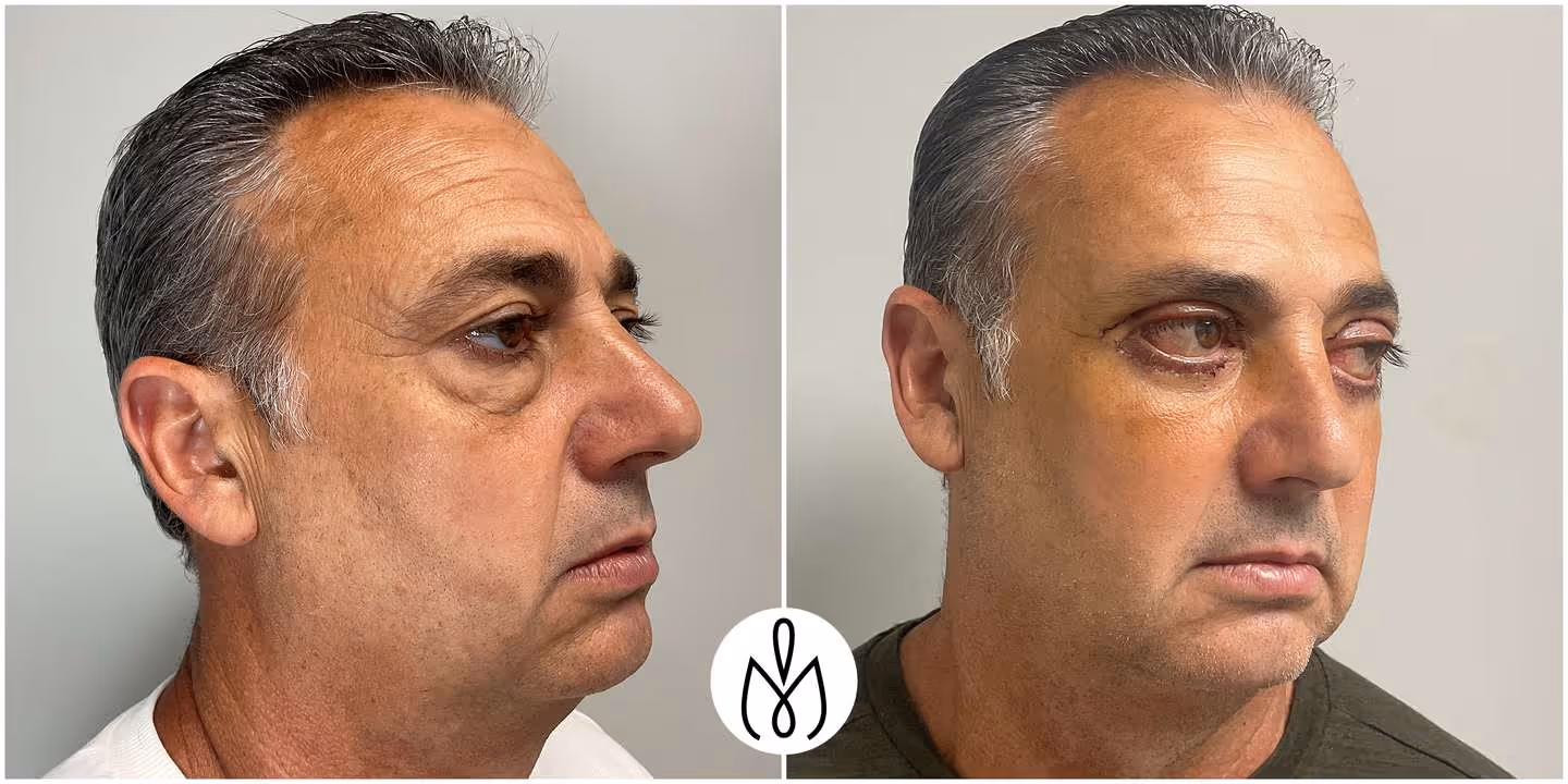 Before,After