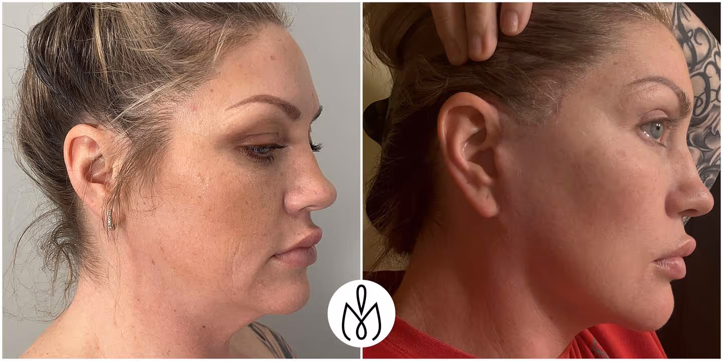 Before,After