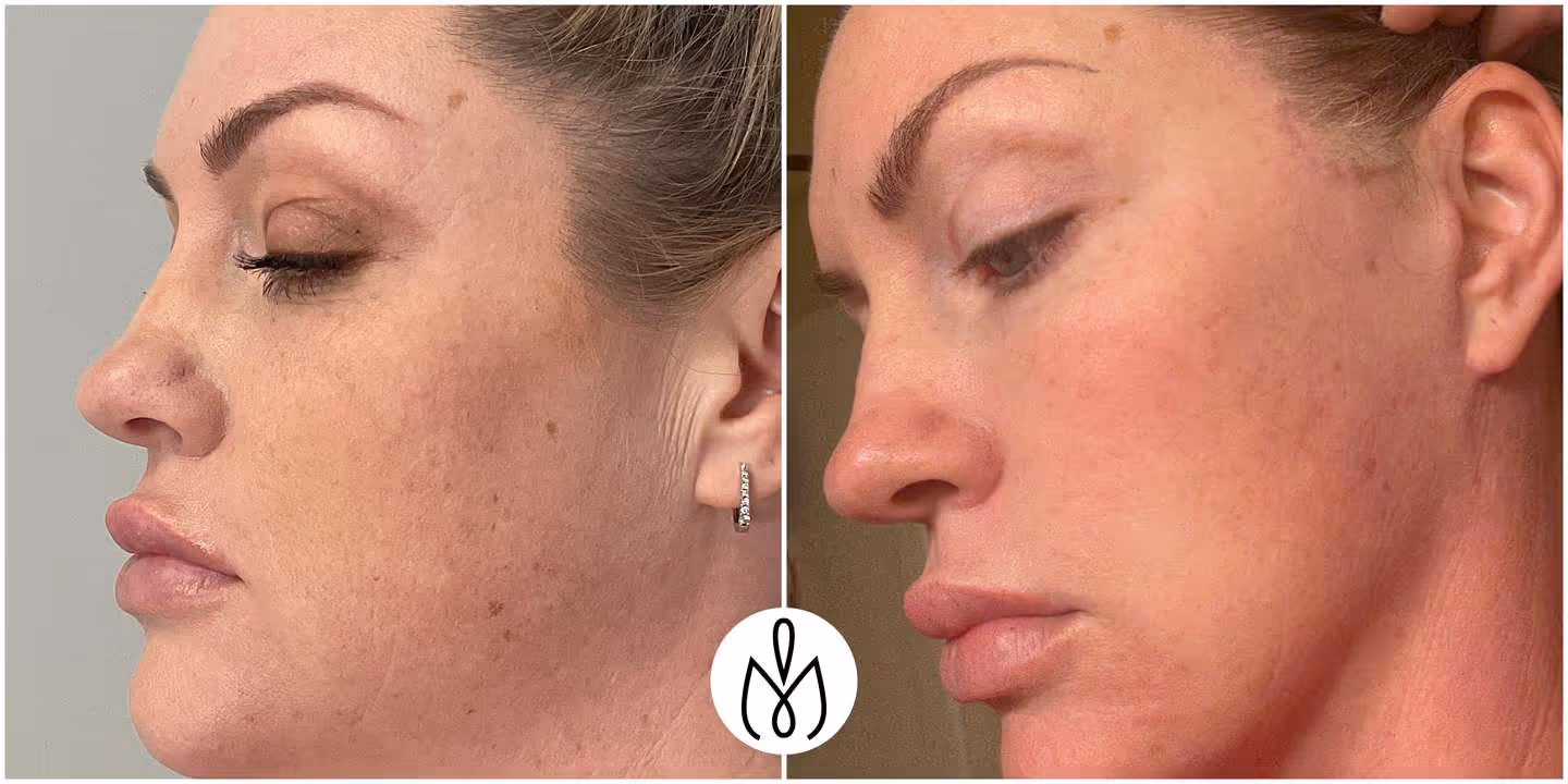 Before,After