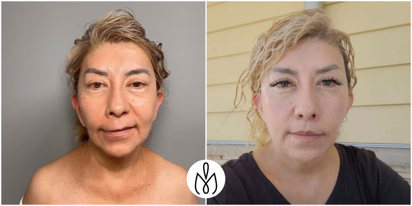 Before,After