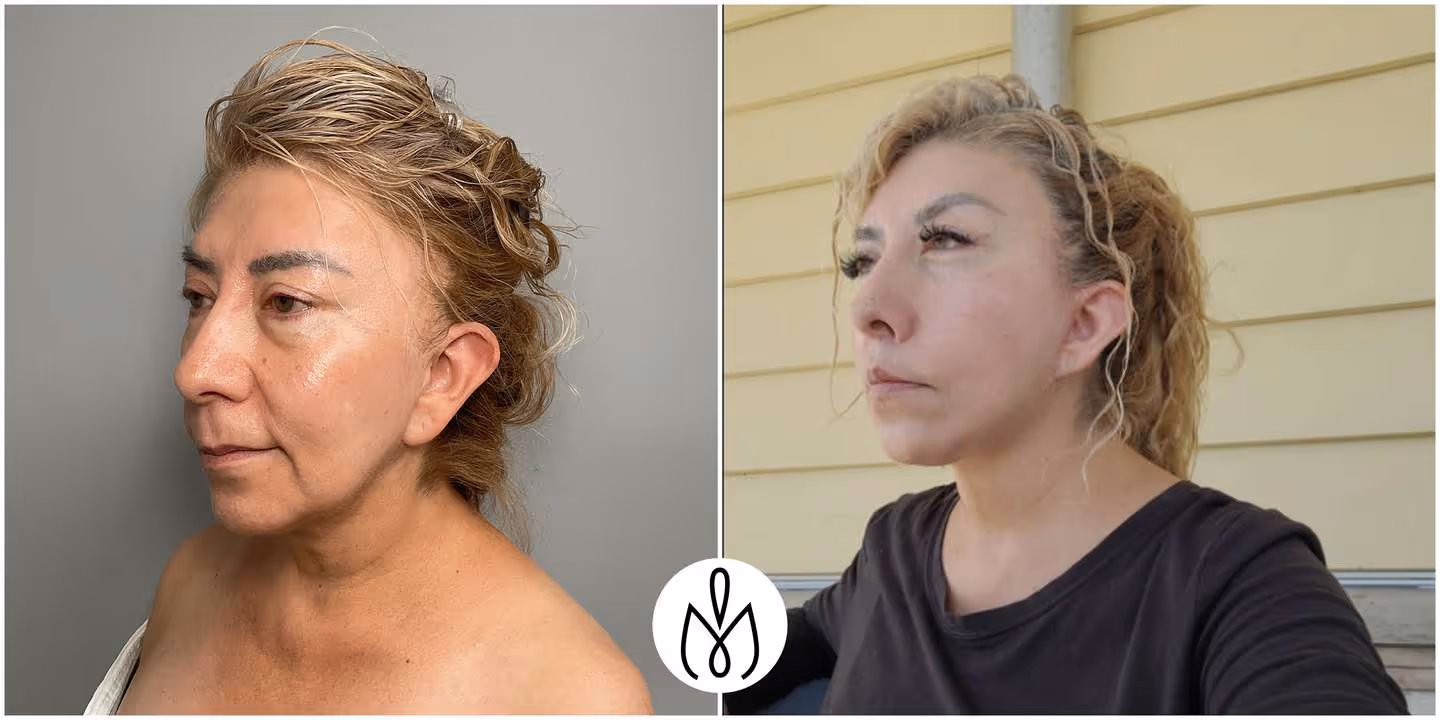 Before,After