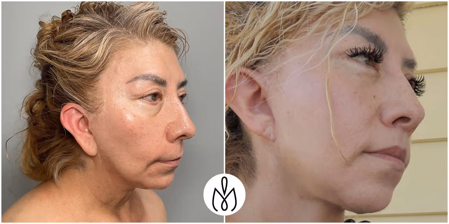 Before,After