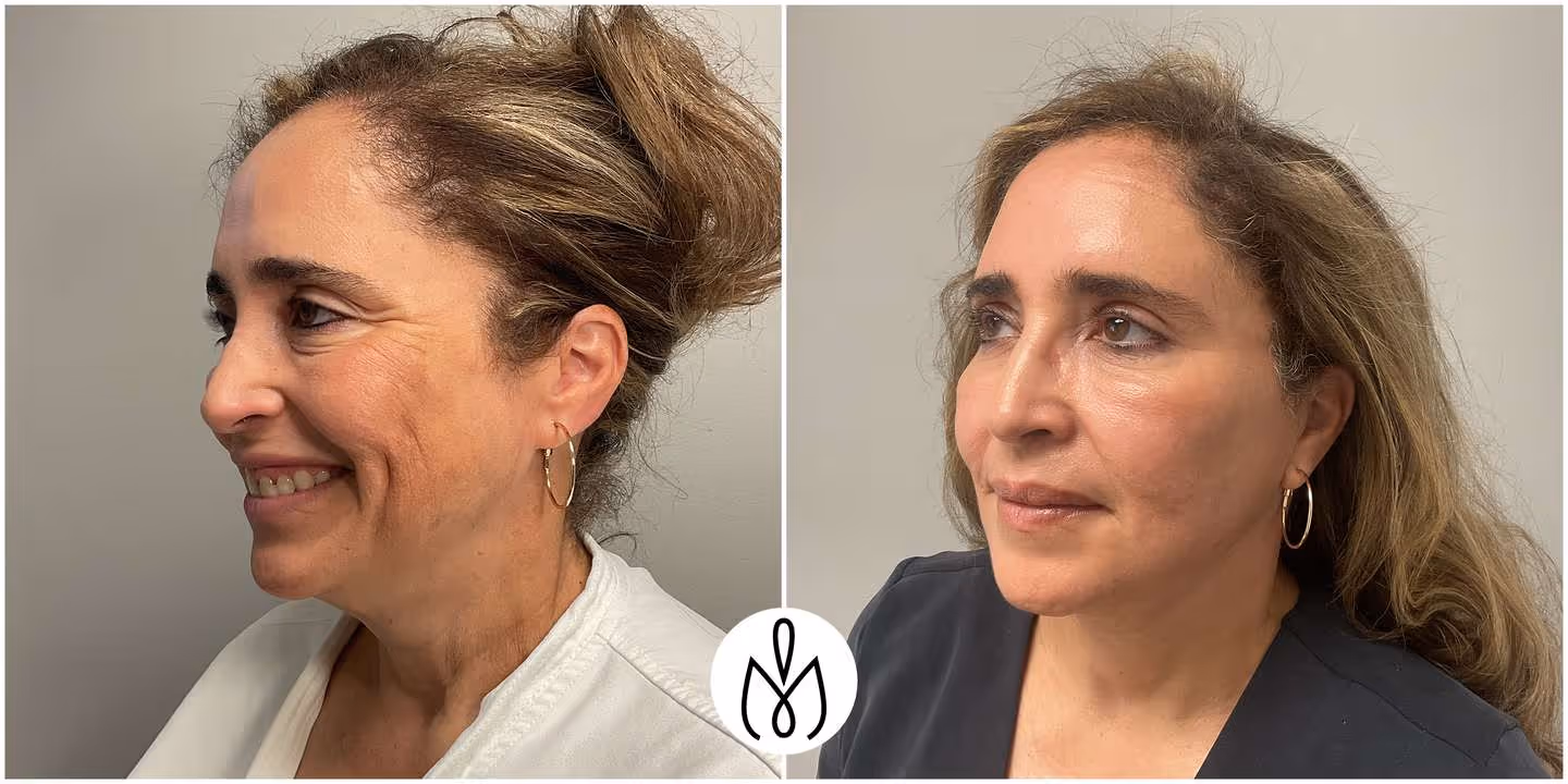 Before,After
