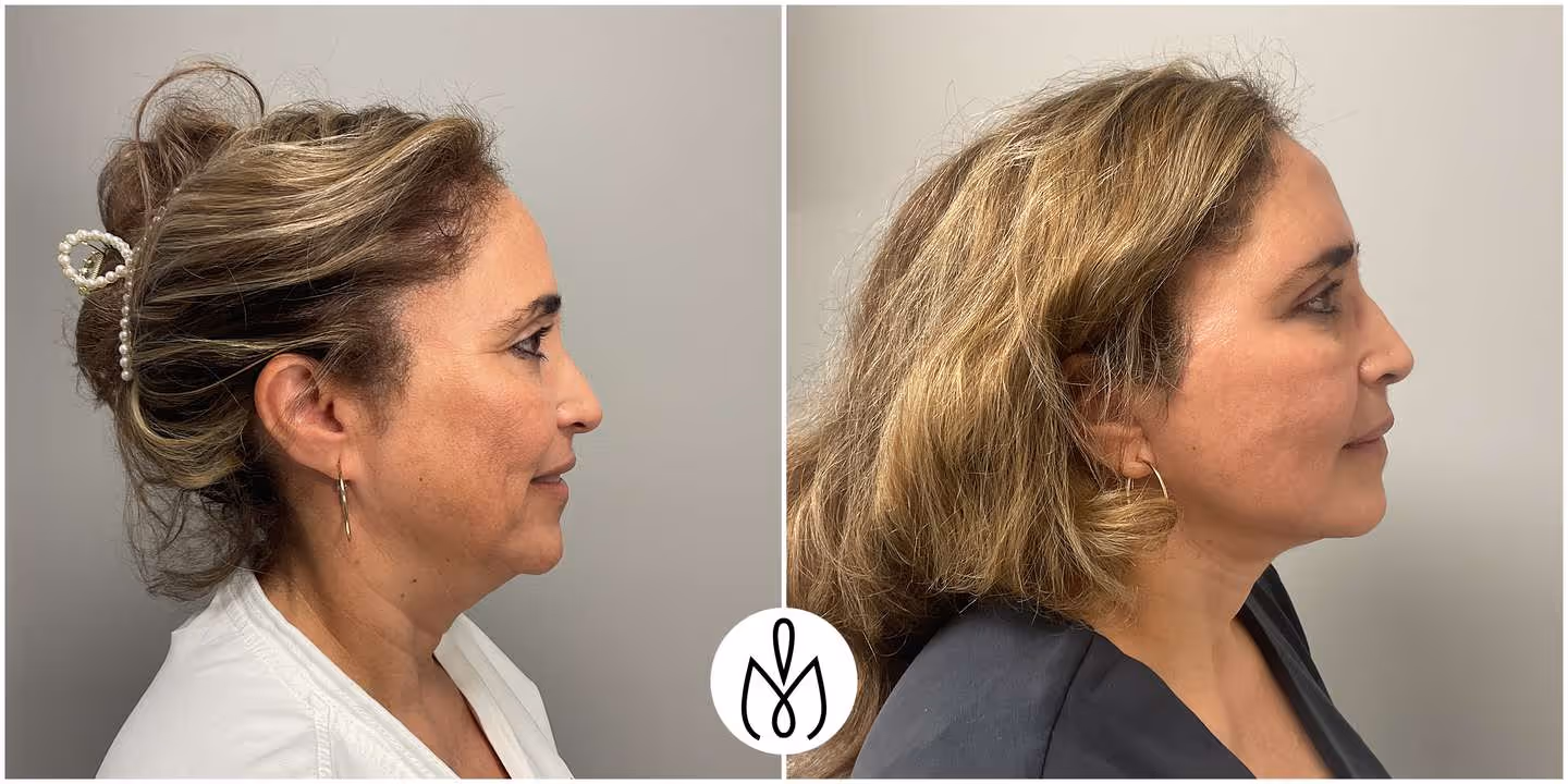 Before,After