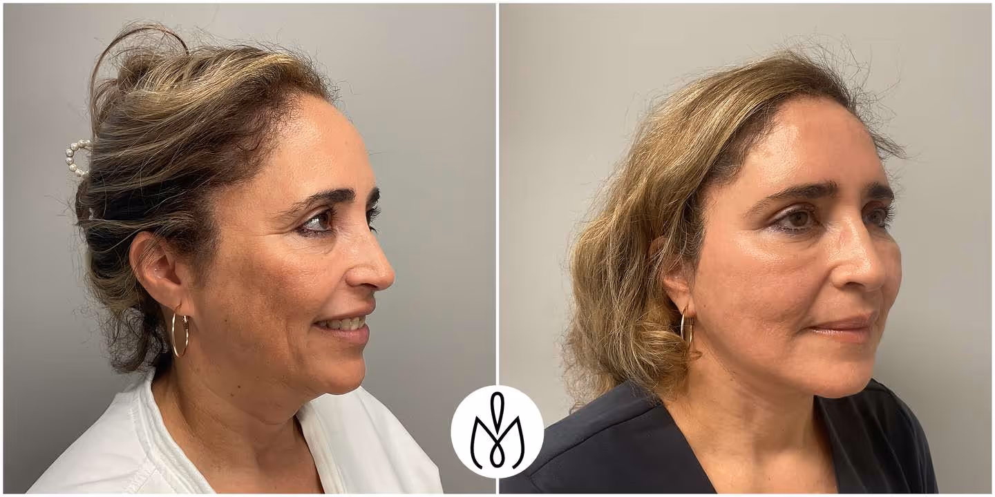 Before,After