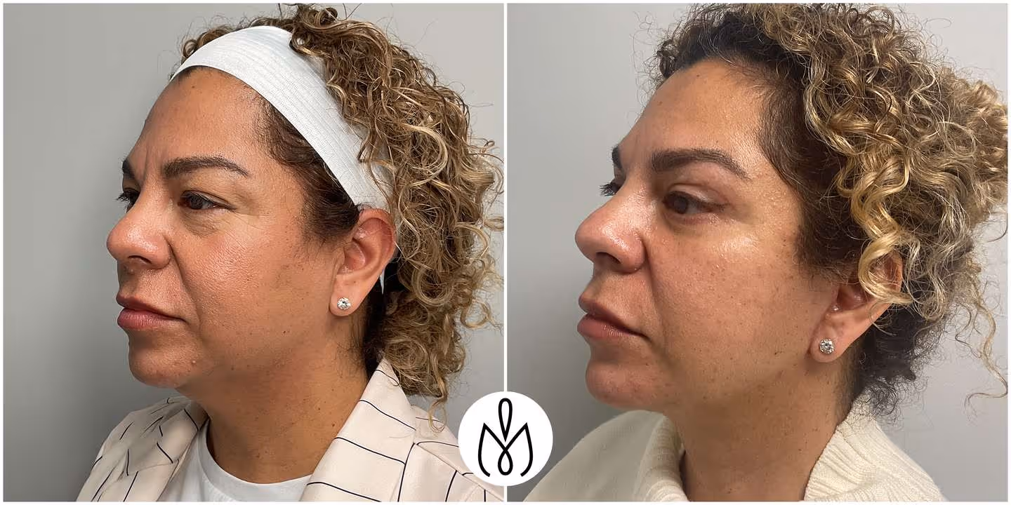 Before,After