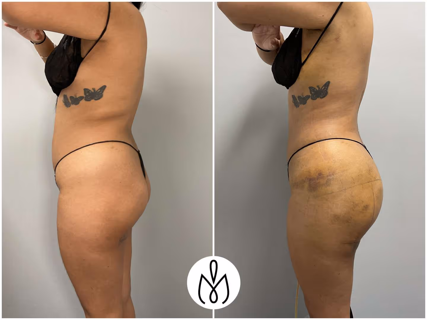 Before,After