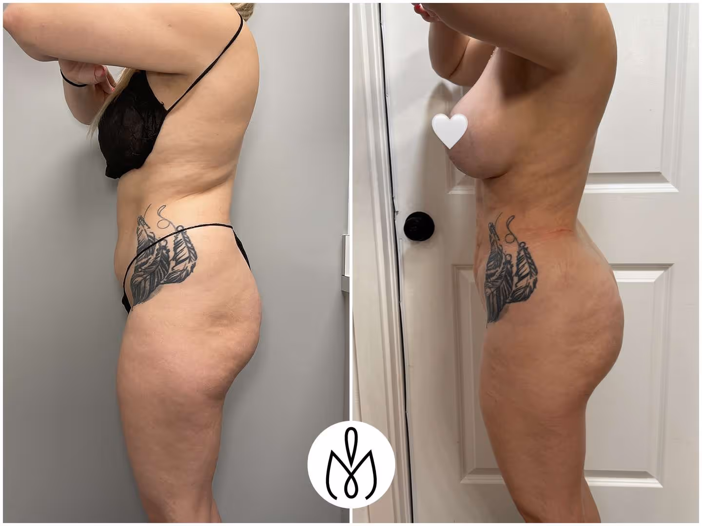 Before,After