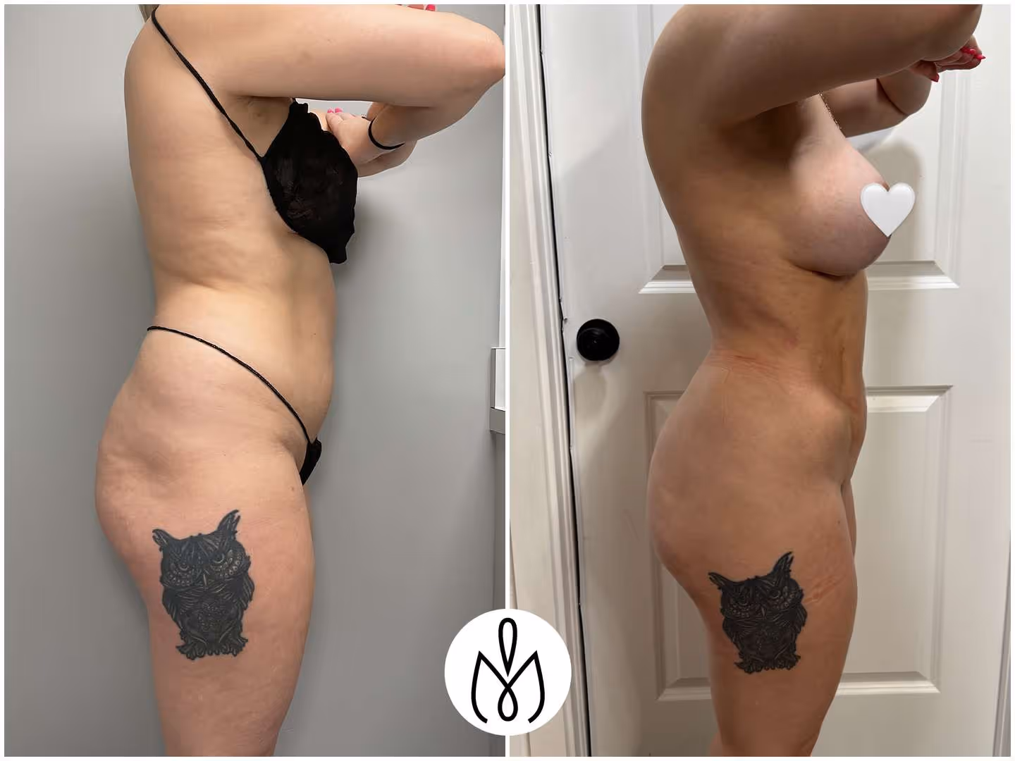 Before,After