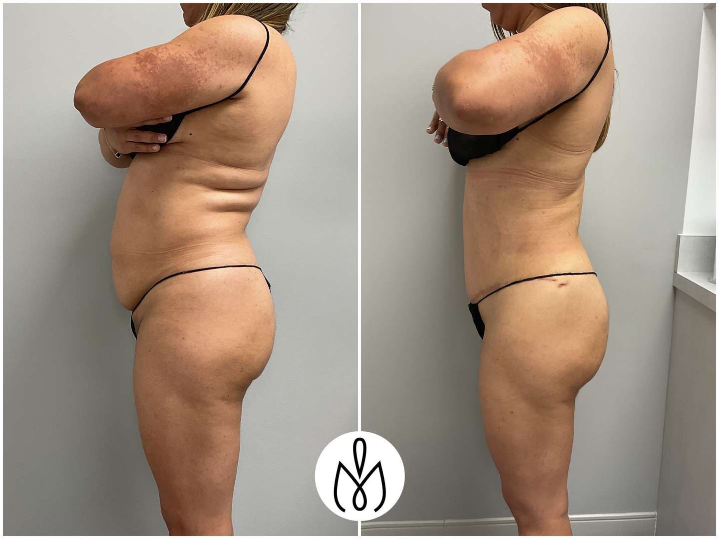 Before,After