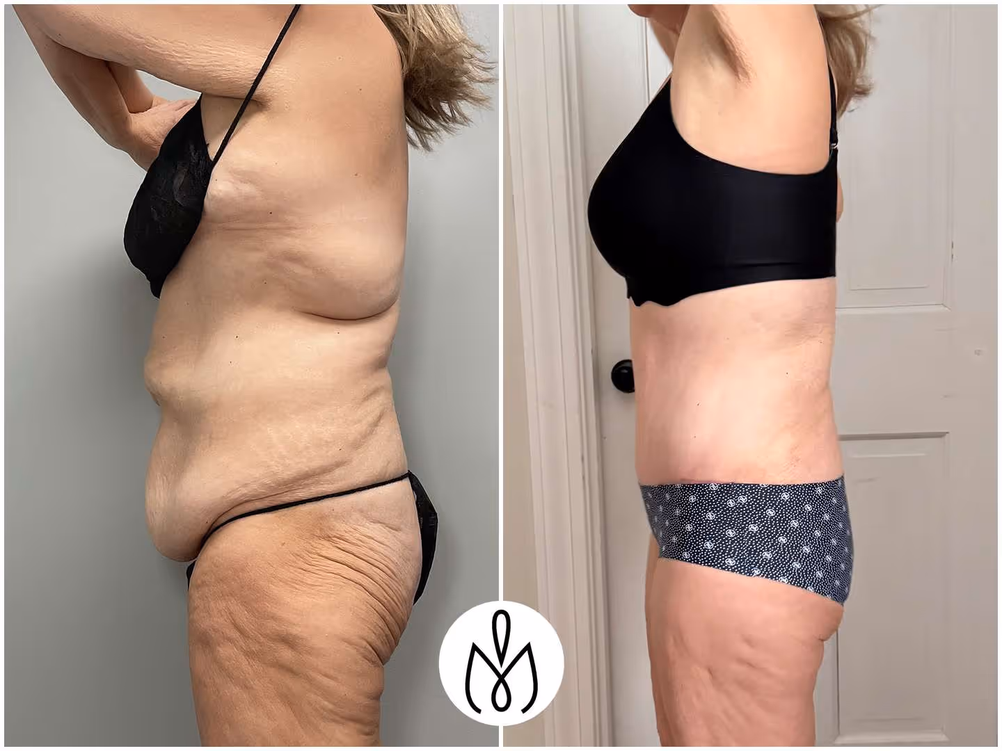 Before,After