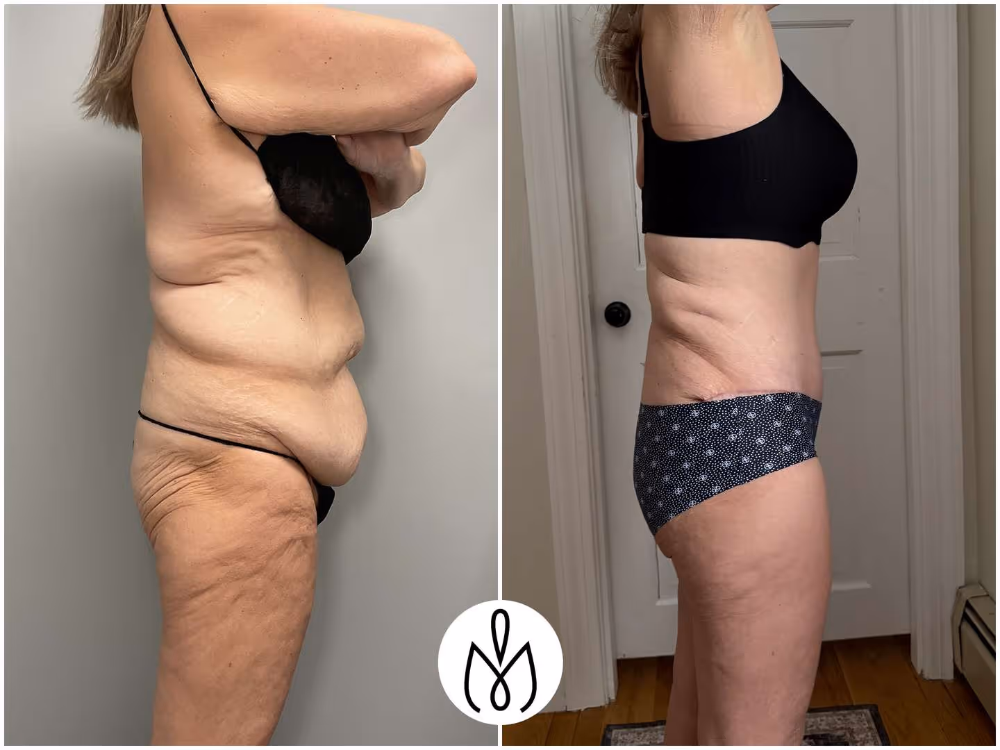 Before,After