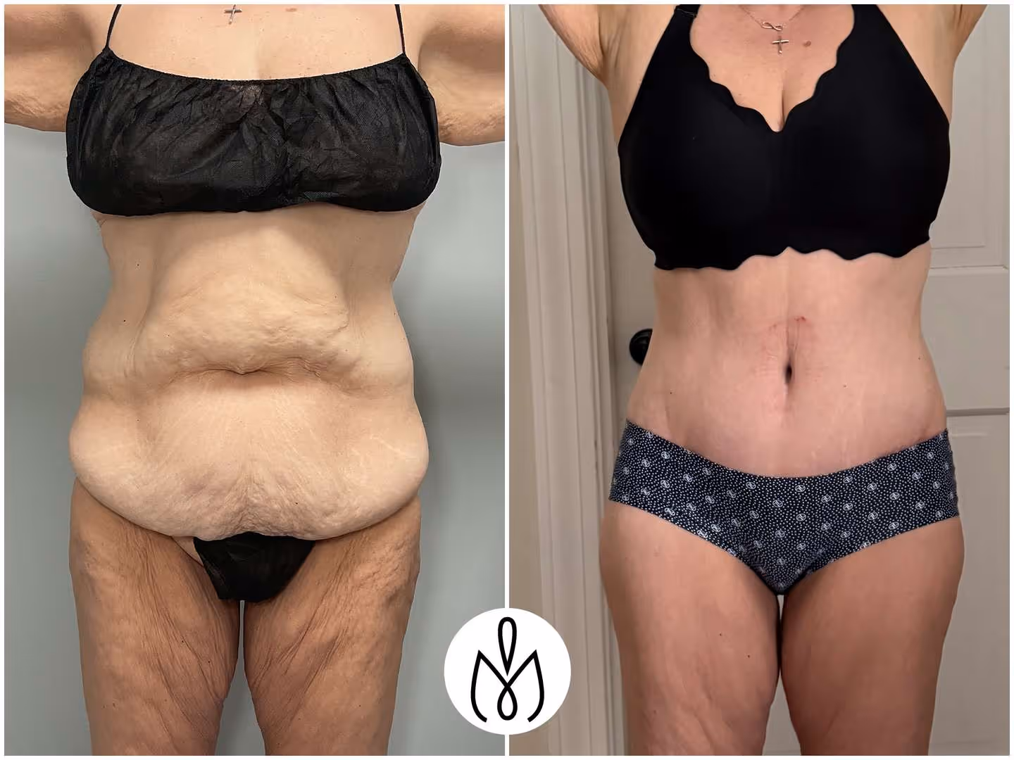Before,After
