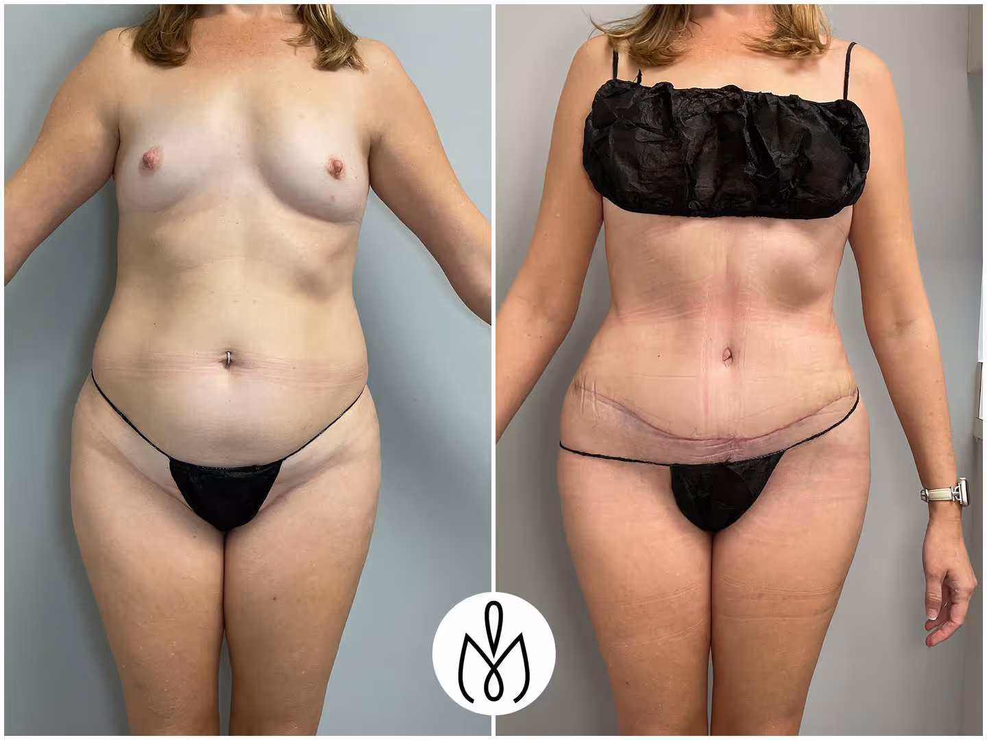 Before,After