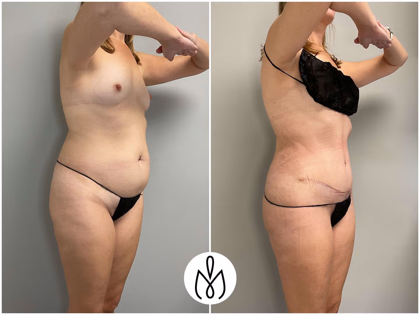 Before,After